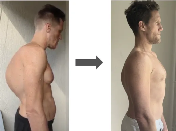 Sam Miller before and after: side-profile posture change without surgery